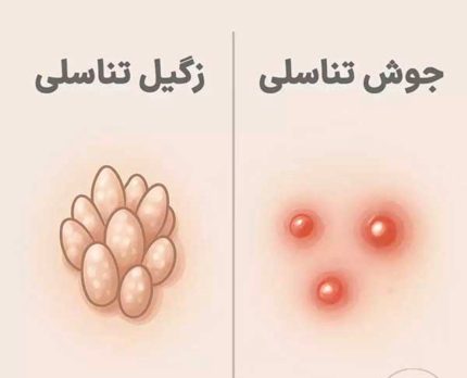 روش جدید درمان زگیل تناسلی _دکتر بهاروند