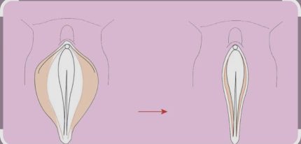 تنگ کردن واژن در خرم اباد