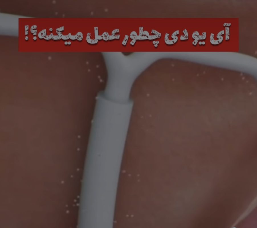 گذاشتن ای یو دی د رخرم اباد توسط خانم دکتر زینب بهاروند