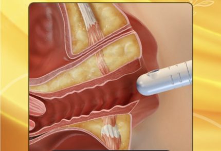 دکترجوانسازی واژن در خرم اباد